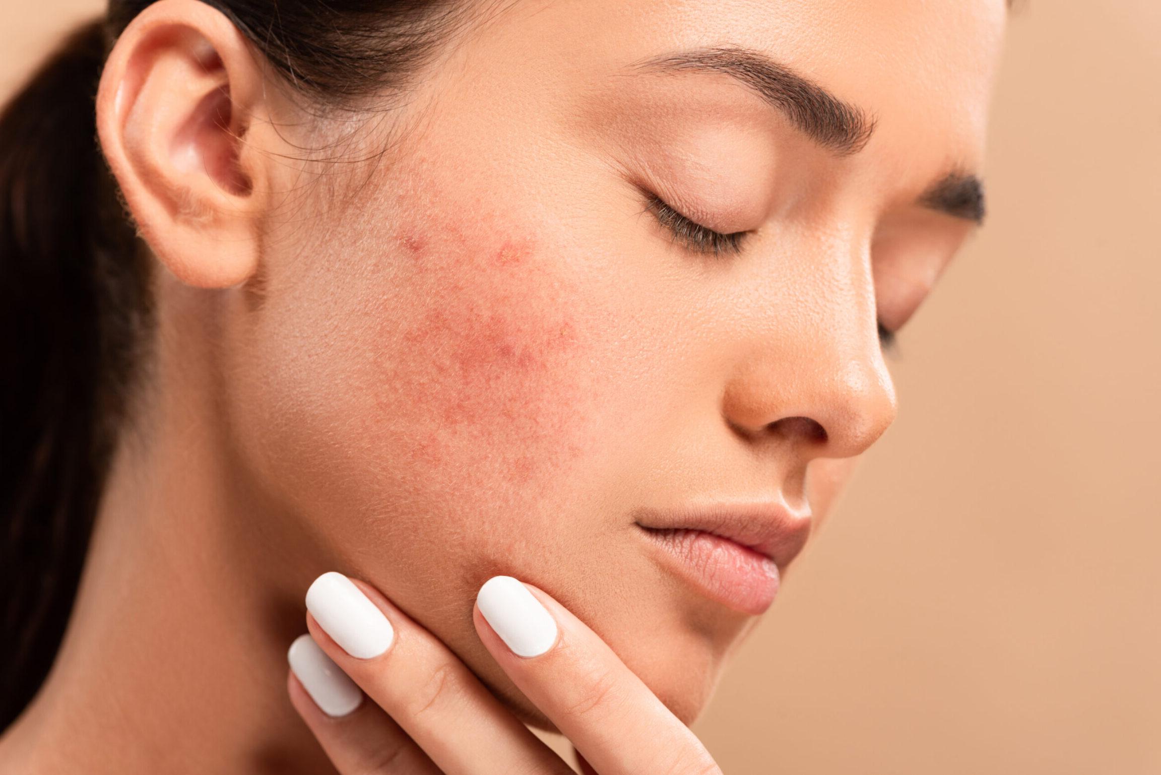 young woman with closed eyes touching face with acne isolated on